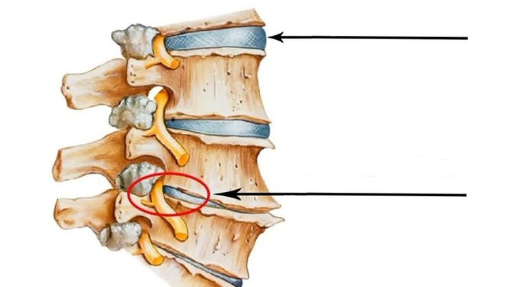 poranění páteře v případě cervikální osteochondrózy