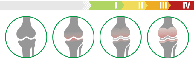 Klinická stadia artrózy kolenního kloubu (stupeň artrózy kolenního kloubu)