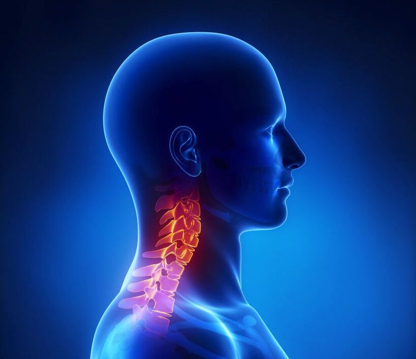 Cervikální osteochondróza je patologie páteře, které se můžete zbavit doma