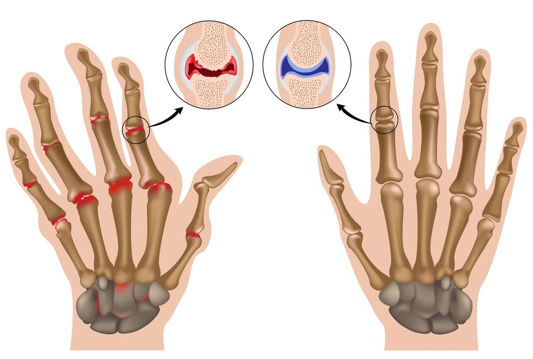 Zdravé a polyartrózou postižené klouby rukou