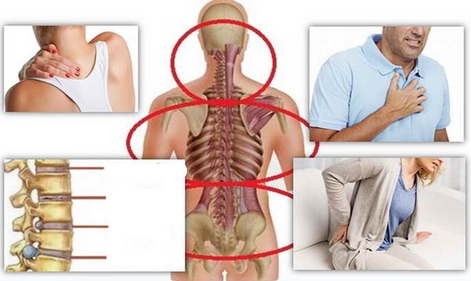 Místa nemoci pro osteochondrosu